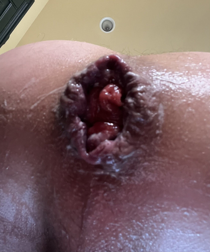StaceyLovesAnal: Ausgestrecktes anales arsch-sperma