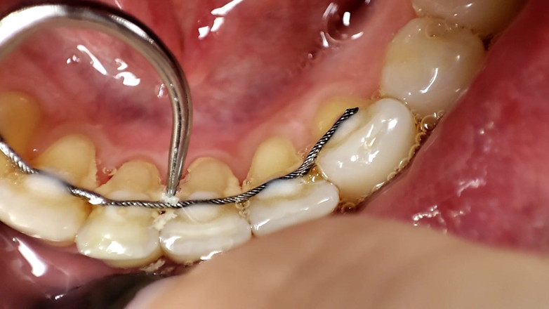 Princess18_: Pulizia dei denti con spazzolino da denti, irrigatore, gancio dentale