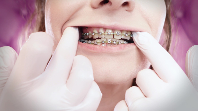 Arya Grander: ASMR: aparat dentar modernizat cu benzi de cauciuc cu lanț-link și...