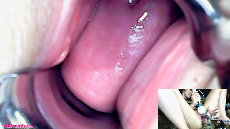AdalynnX: AdalynnX - endoscopio espéculo hitachi vib