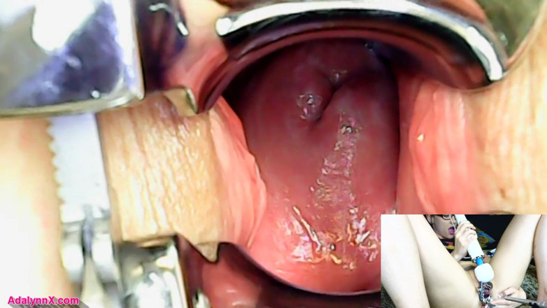 AdalynnX: AdalynnX - endoscopio espéculo hitachi vib