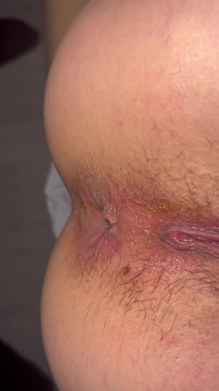Anonimii: Rough Anal