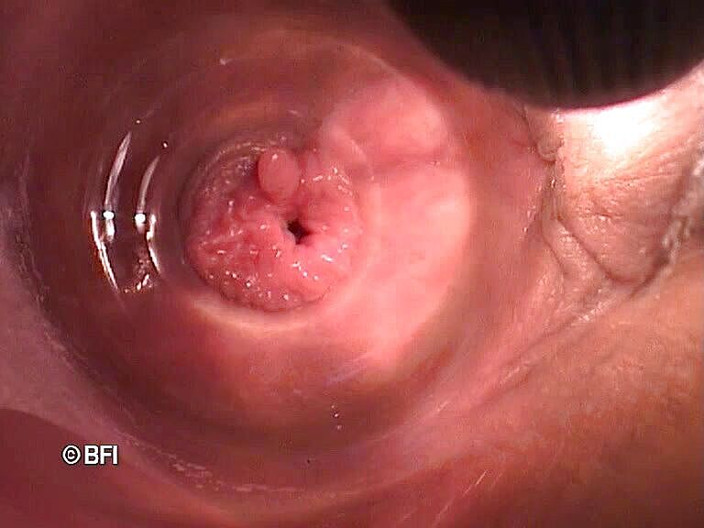 Pegging insertion: 奇怪的文件 162