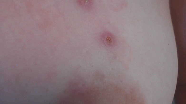 Miodelka: Mes seins flasques ont servi de cendrier et montrant à quoi...