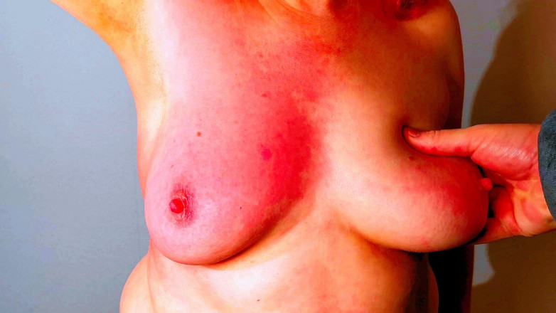 Bouncy Tits Action: 500 goresan di toket kanannya