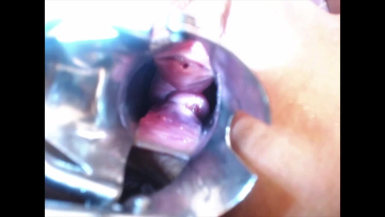 Littlesubgirl: Spekulum Cervix &amp; Peperiksaan Dubur – Pemandangan Hebat Di Dalam