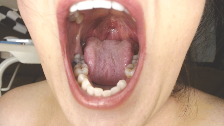 Abby Anna: Глотка и рот слюнявы, строки Uvula, миндалины Uvula