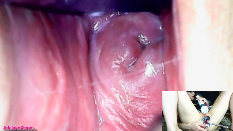 AdalynnX: Adalynnx - Endoscope, spéculum hitachi, vib
